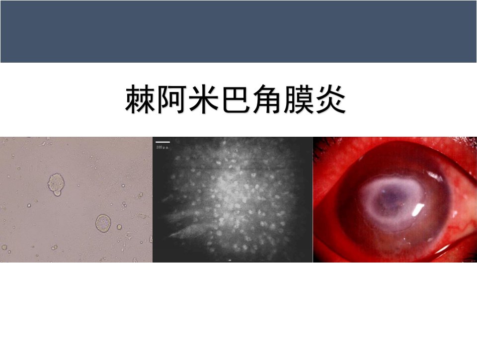 《棘阿米巴角膜炎》PPT课件