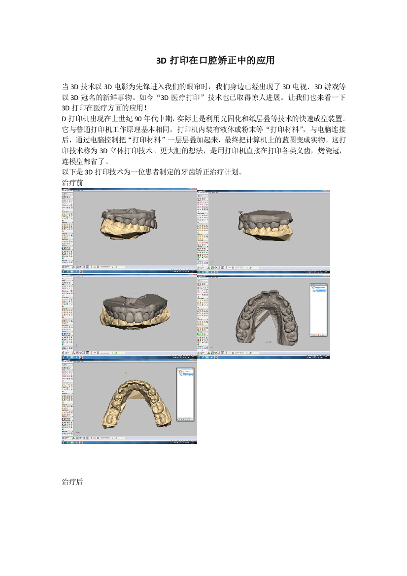 3D打印在口腔矫正中的应用