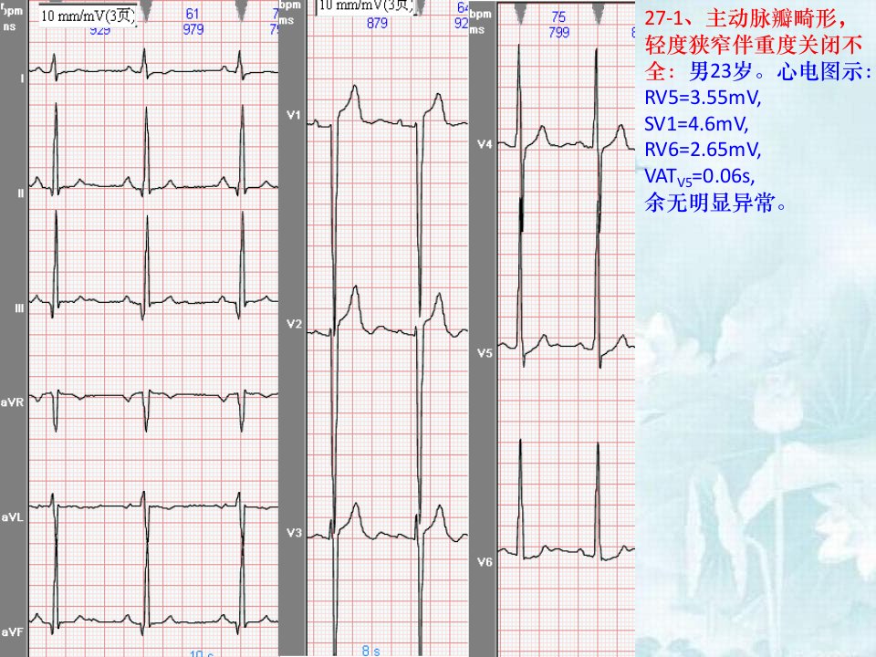 先天性心脏病心电课件