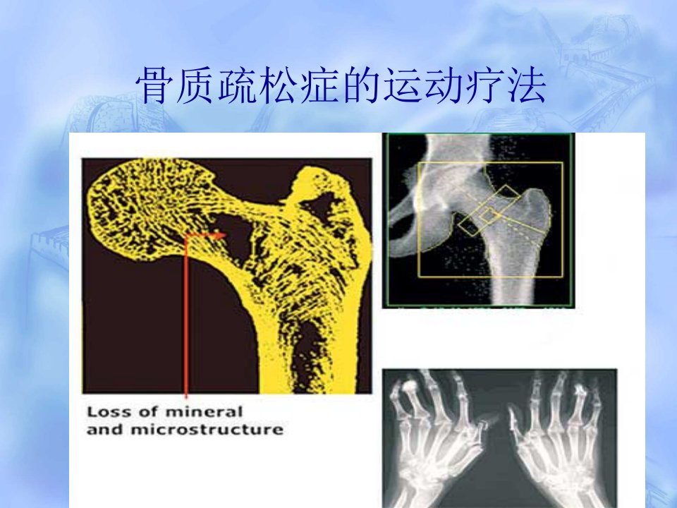 骨质疏松症的运动疗法