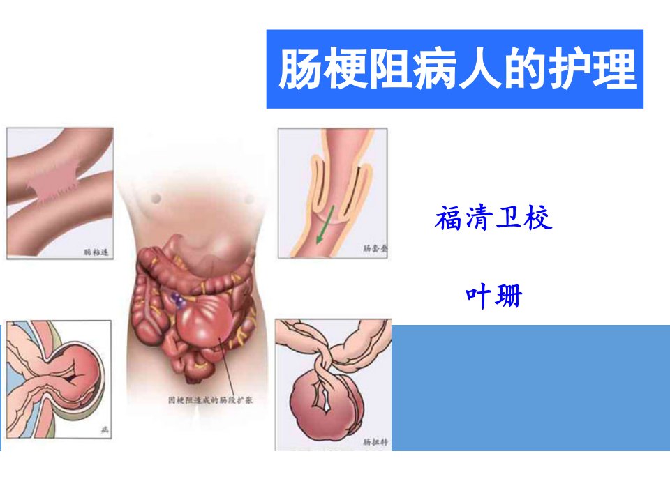 肠梗阻病人的护理