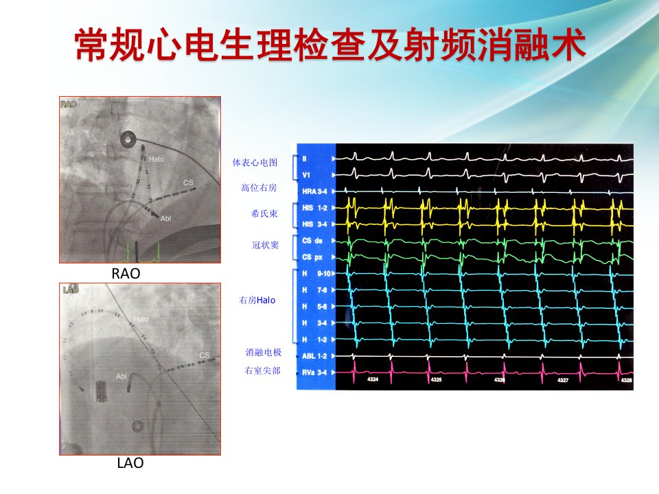 全三维室上速处理课件