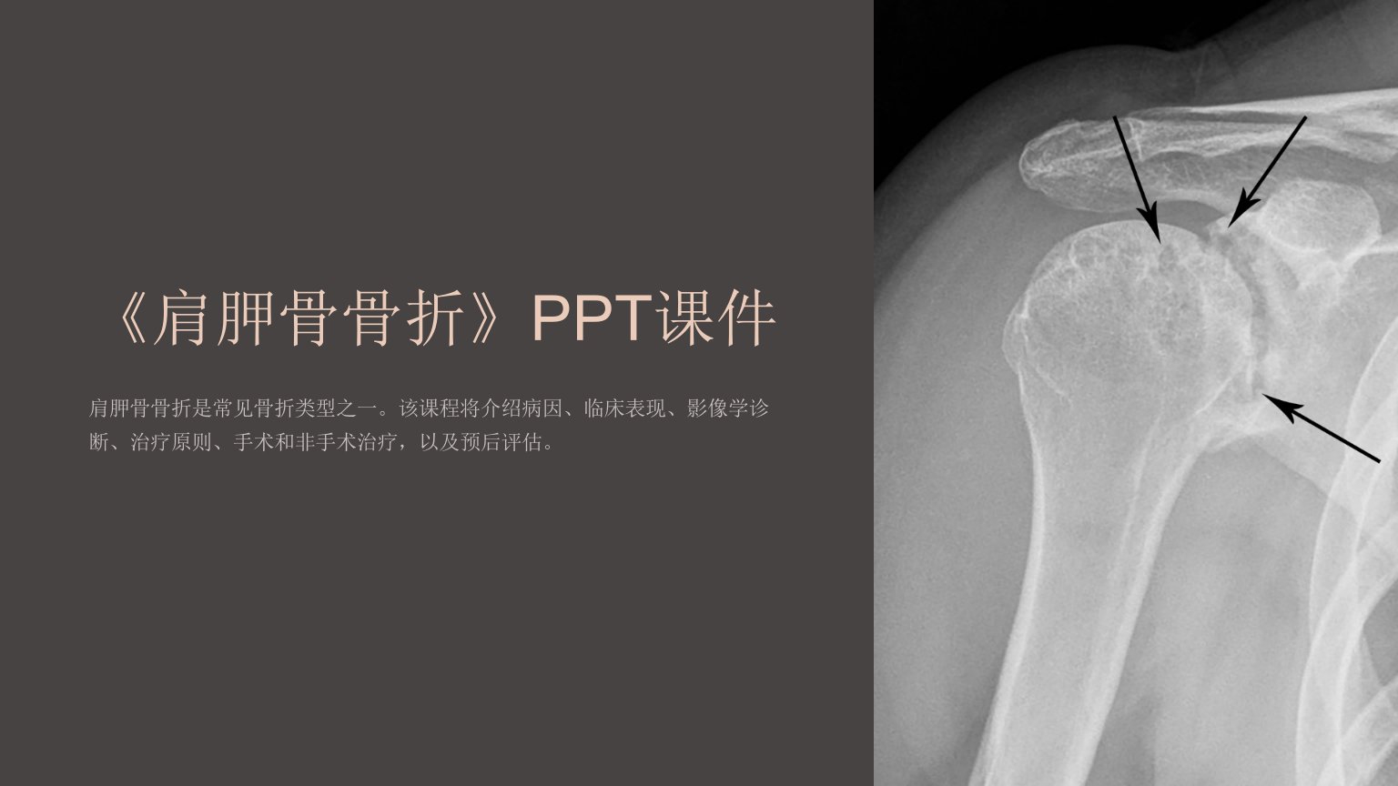 《肩胛骨骨折》课件