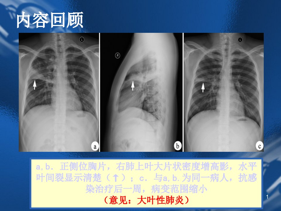 医学影像诊断学-呼吸系统-PPT课件