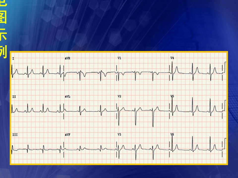 心电图基础知识含常见异常心电图ppt课件