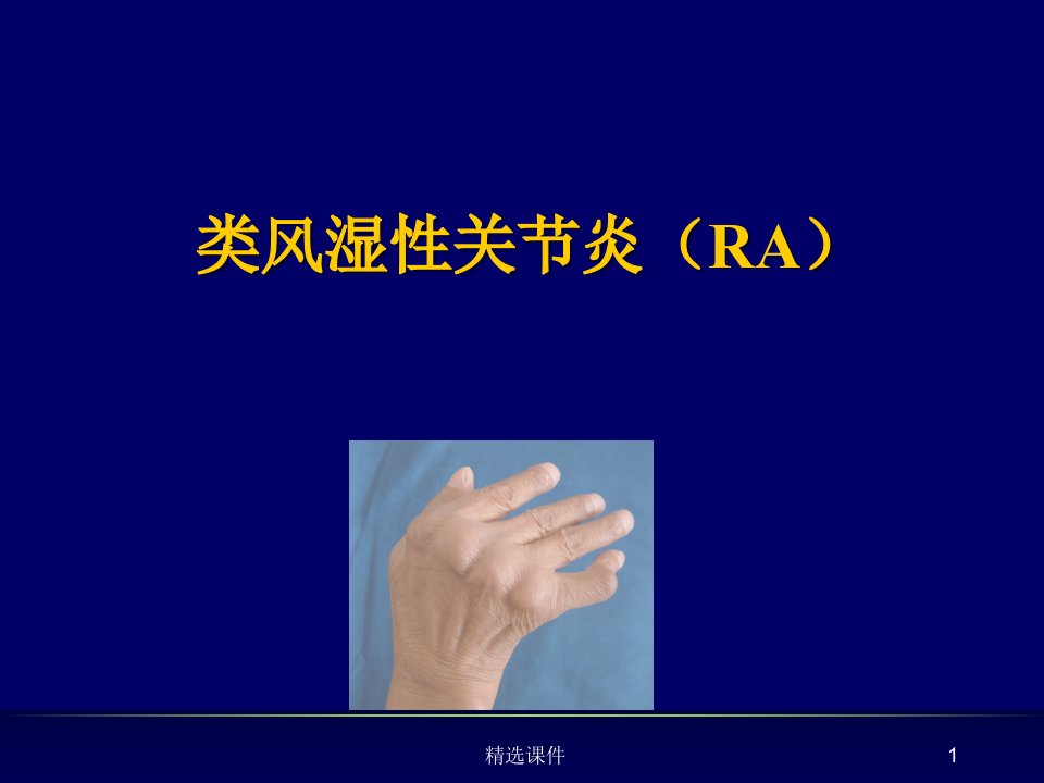 内科学课件类风湿性关节炎