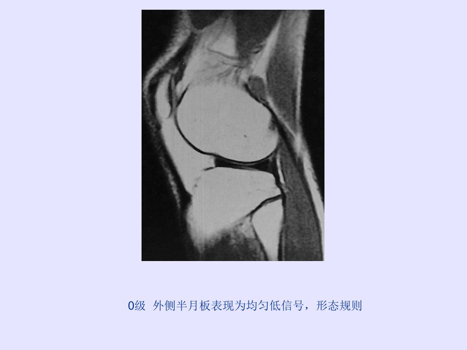 膝关节半月板mri