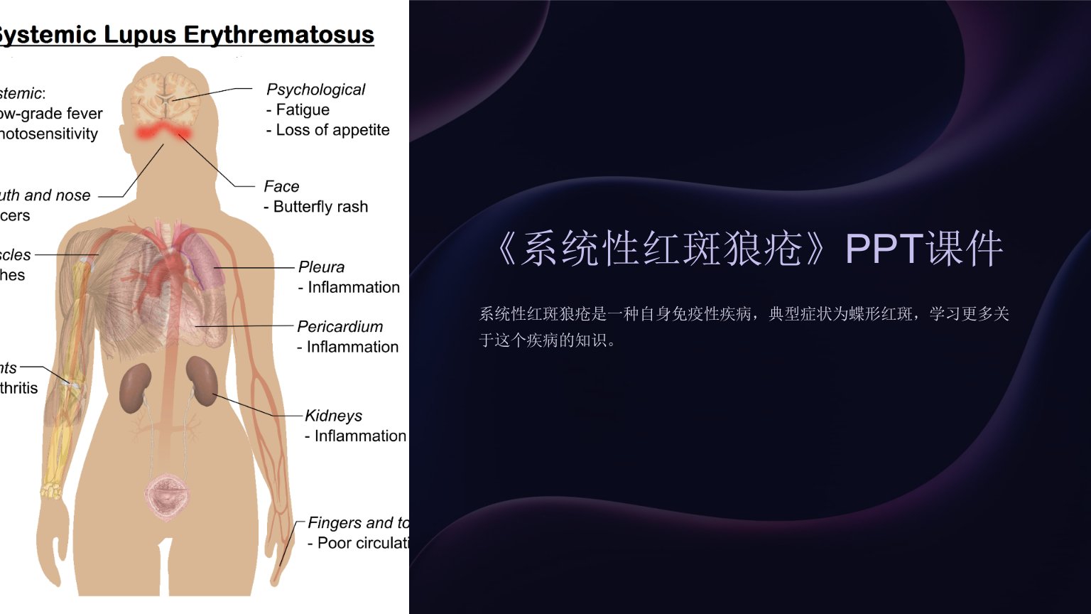 《系统性红斑狼疮》课件