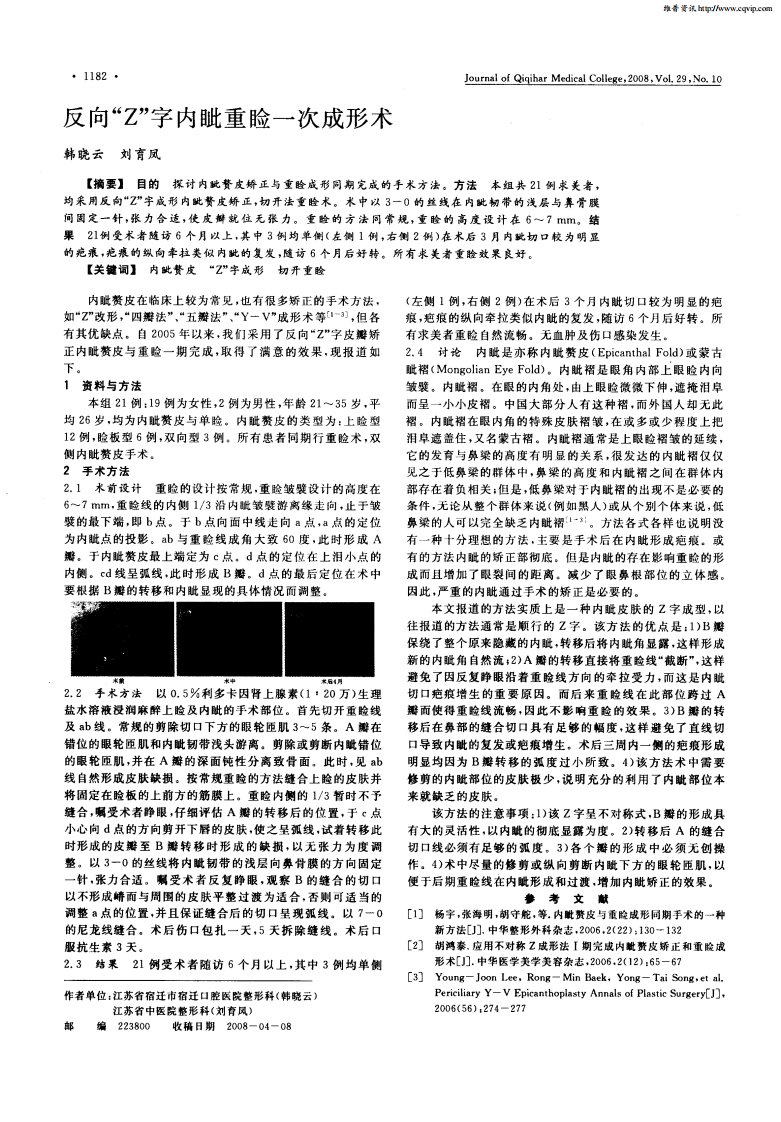 反向“Z”字内眦重睑一次成形术.pdf