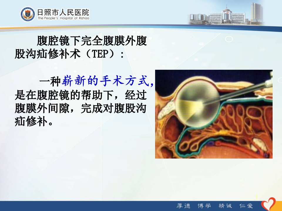 腹腔镜下完全腹膜外腹股沟疝修补术TEP讲义