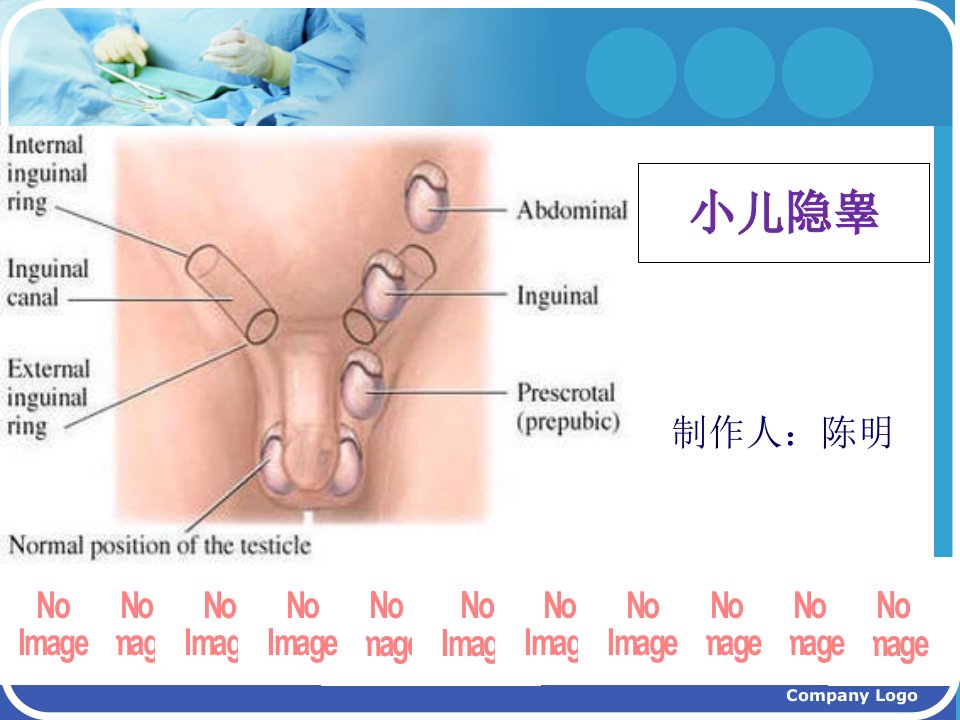 小儿隐睾