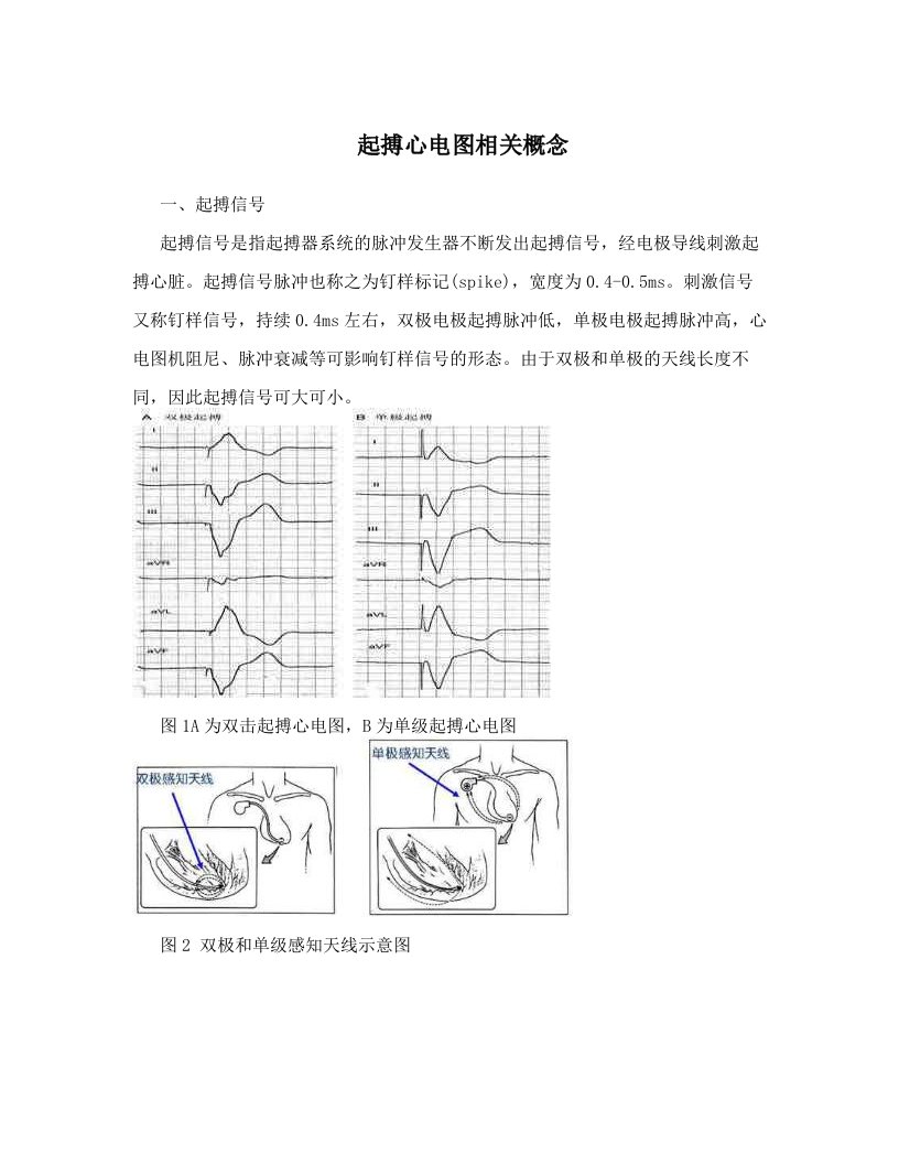 起搏心电图相关概念