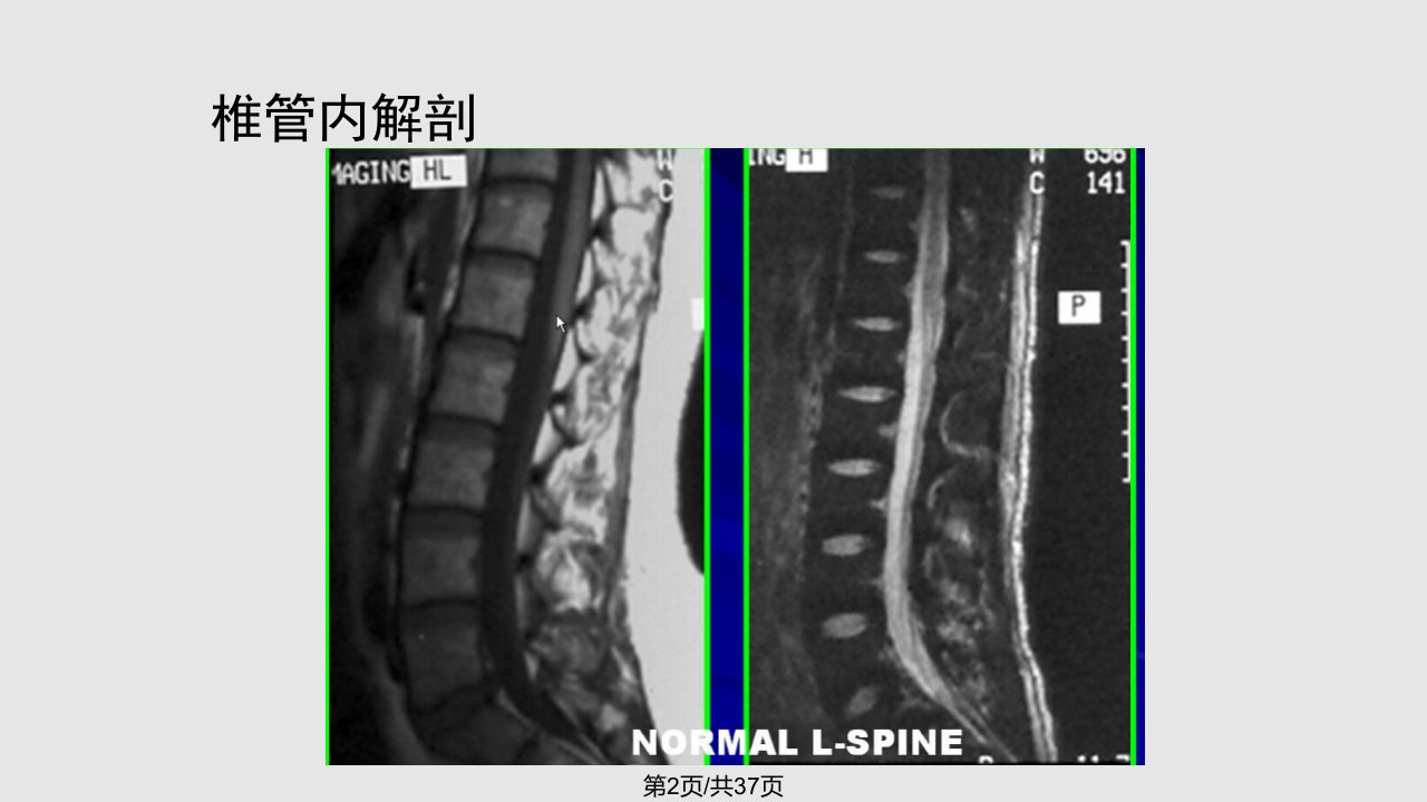 脊髓和椎管内病变