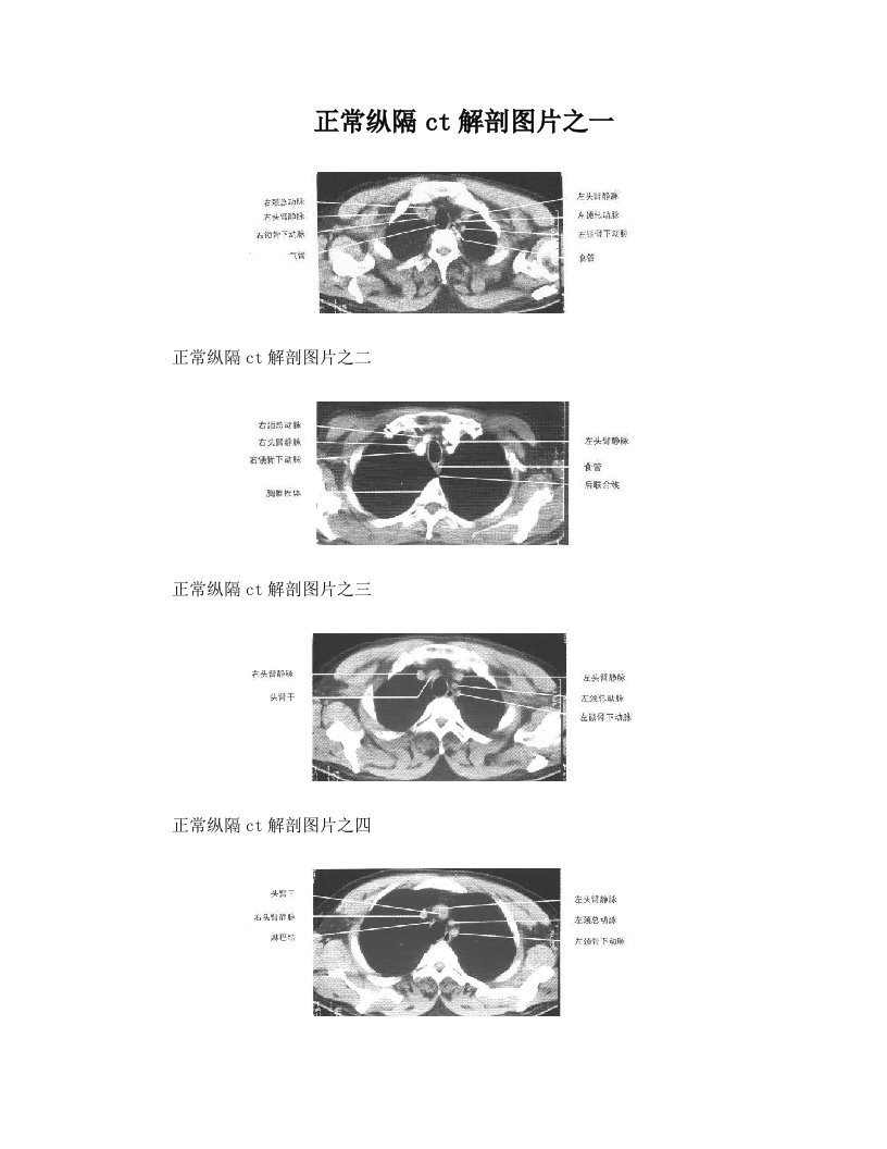 正常纵隔ct解剖图片之一