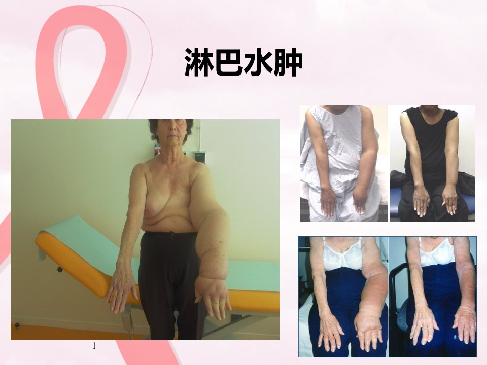 乳腺癌术后淋巴水肿康复治疗课件