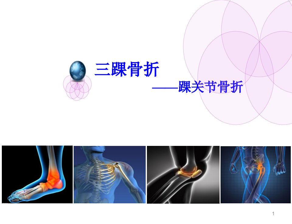 三踝骨折ppt课件