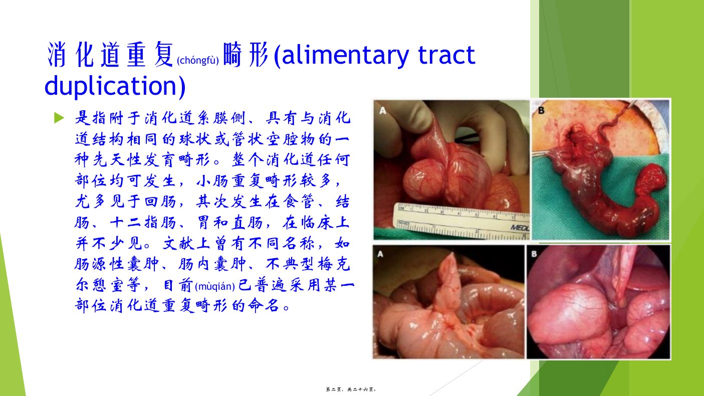 医学专题消化道重复畸形97