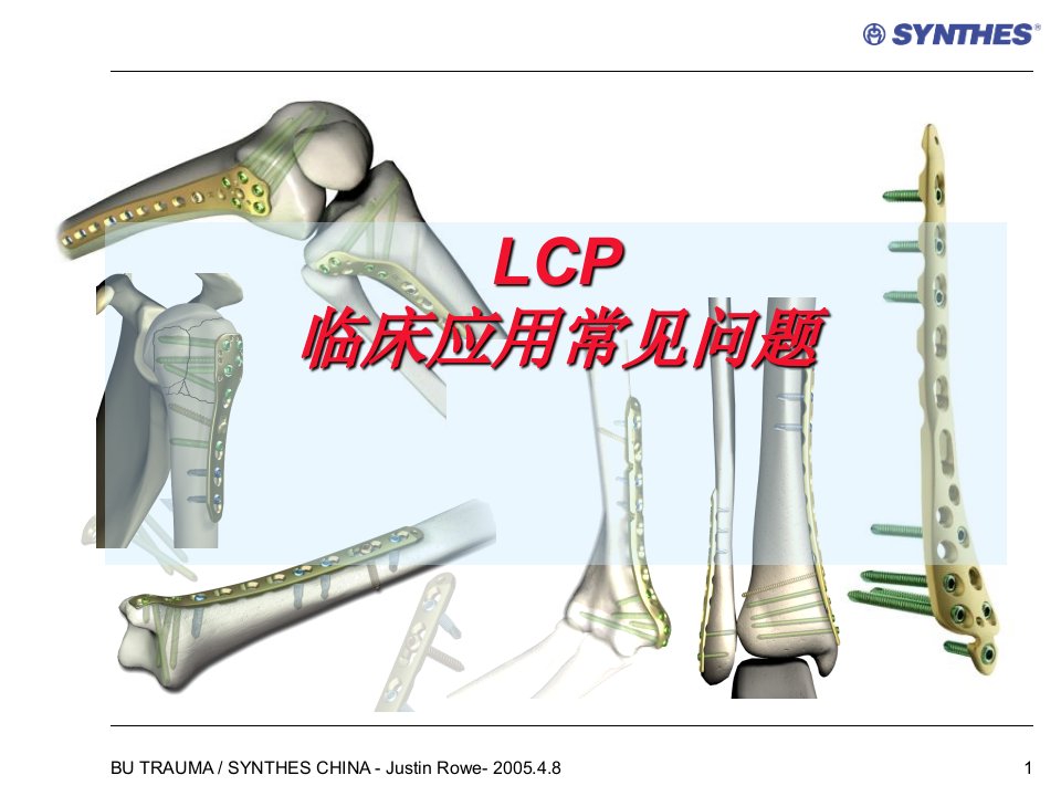 锁定内固定系统临床应用常见问题LCP-Qu