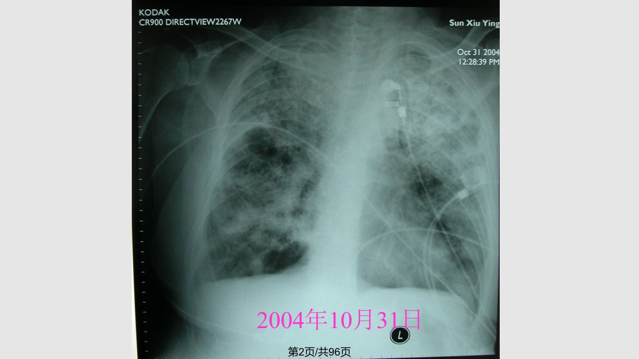 院内感染细菌耐药问题及抗生素应用策略