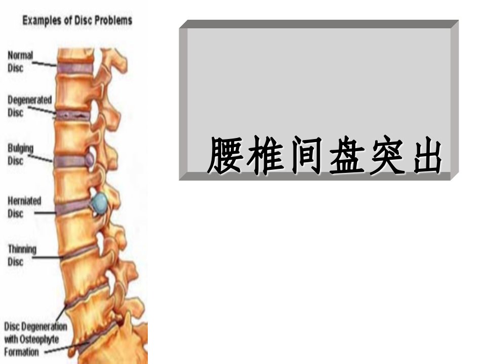 (腰椎间盘突出与腰肌劳损)运动康复ppt课件