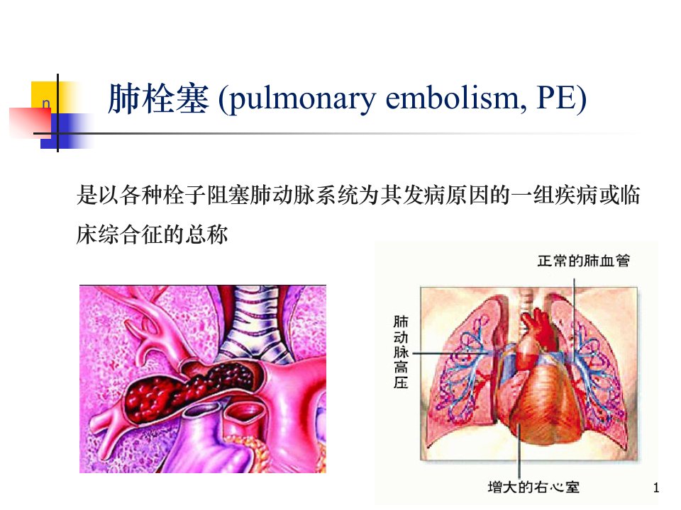 肺栓塞的发病机制诊断和处理ppt课件