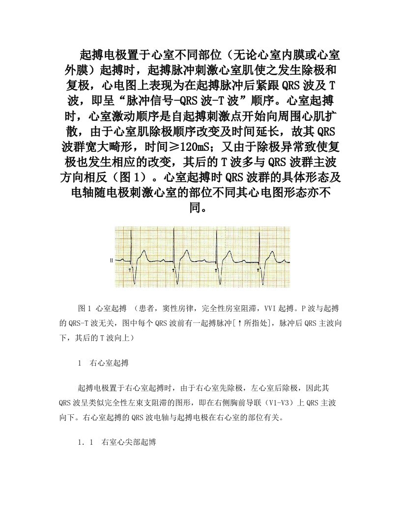 图解心室不同部位起搏心电图