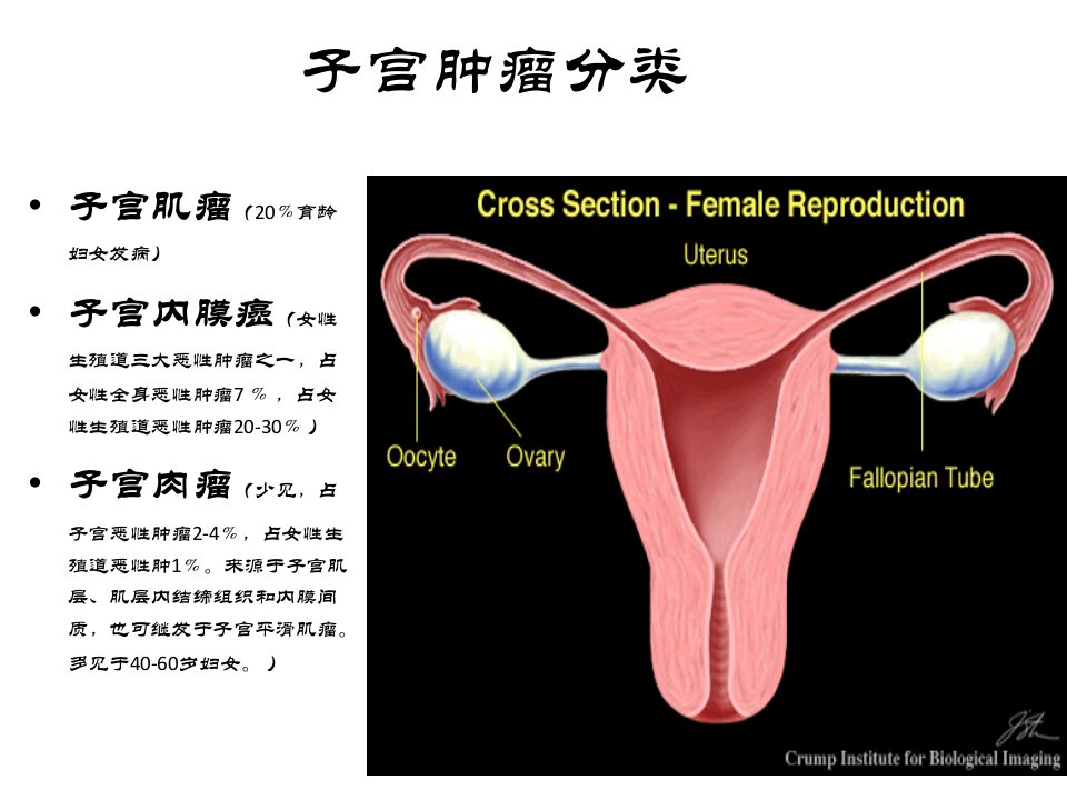 子宫肿瘤幻灯片讲稿