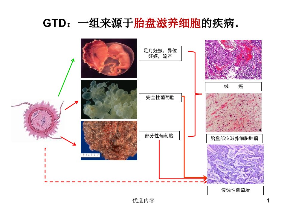 葡萄胎参考课件上课课堂