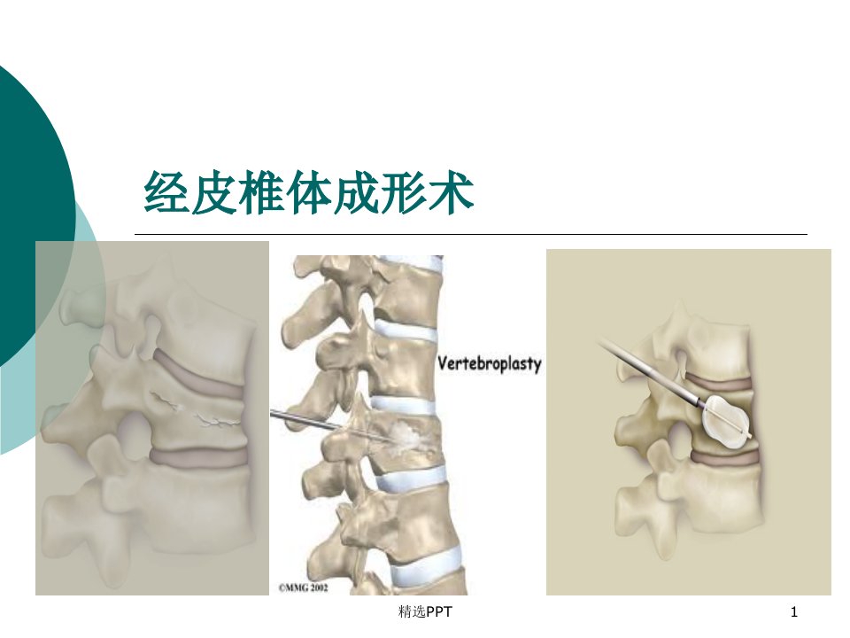 经皮椎体成形术课件