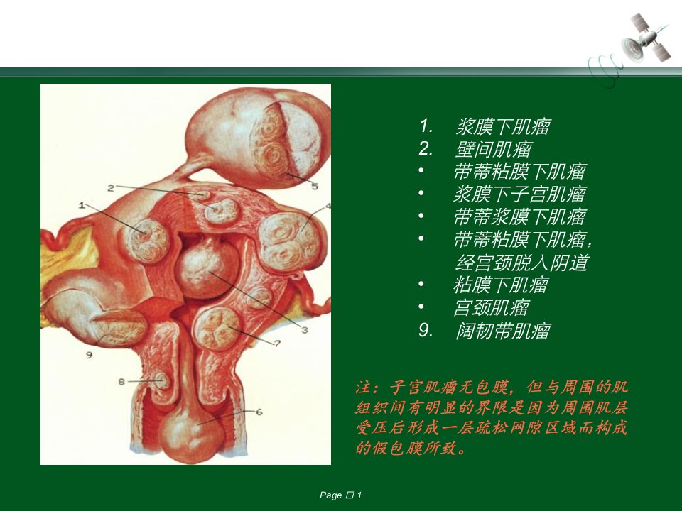 最新子宫肌瘤1PPT课件