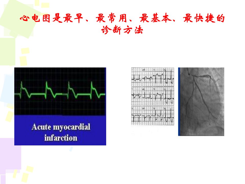 最新心电图在急性冠状动脉综合征中的应用龙华医院PPT课件