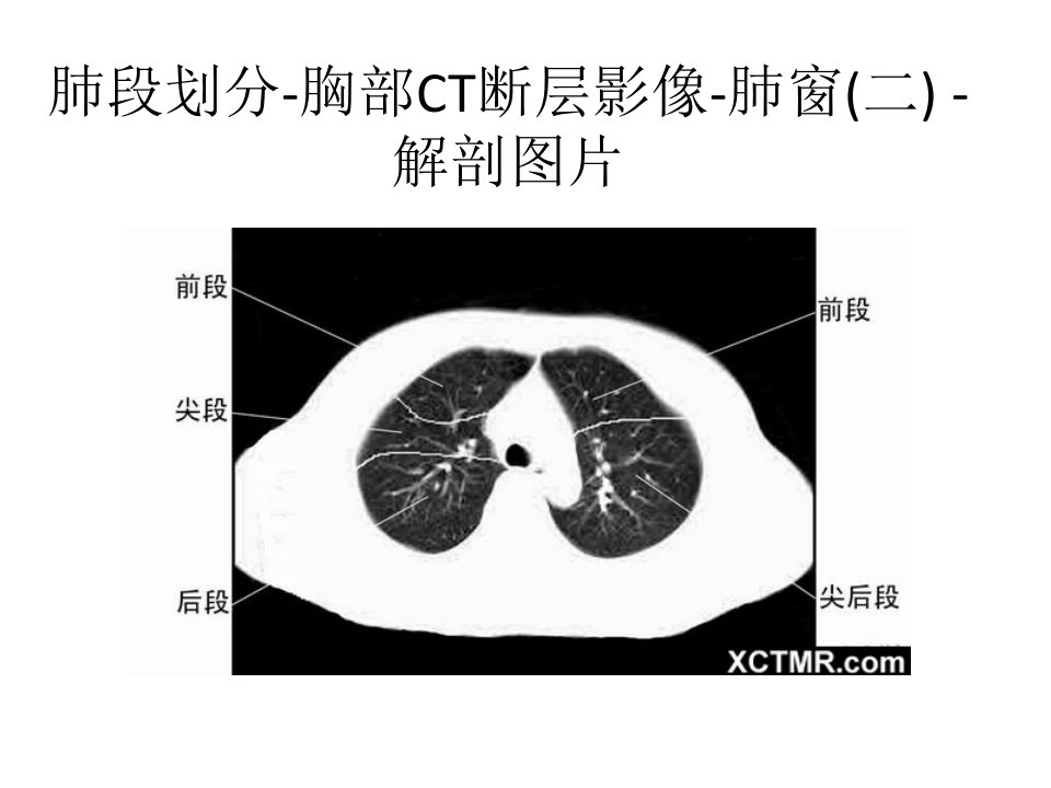 胸部CT肺段划分讲义