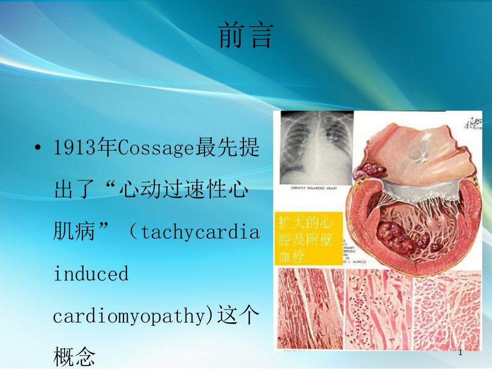 心动过速心肌病PPT课件