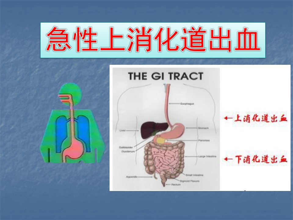 急性上消化道出血医学PPT课件