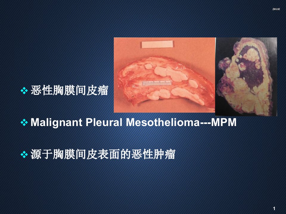 恶性胸膜间皮瘤ppt课件