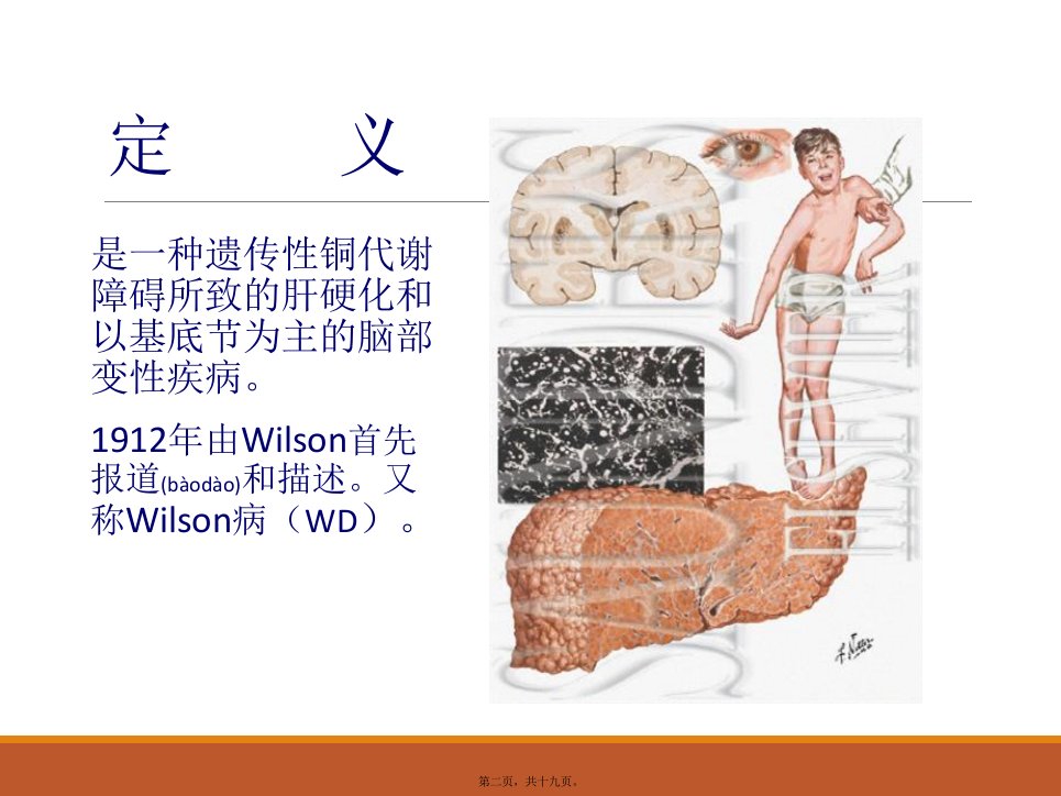 医学专题肝豆状核变性精简版