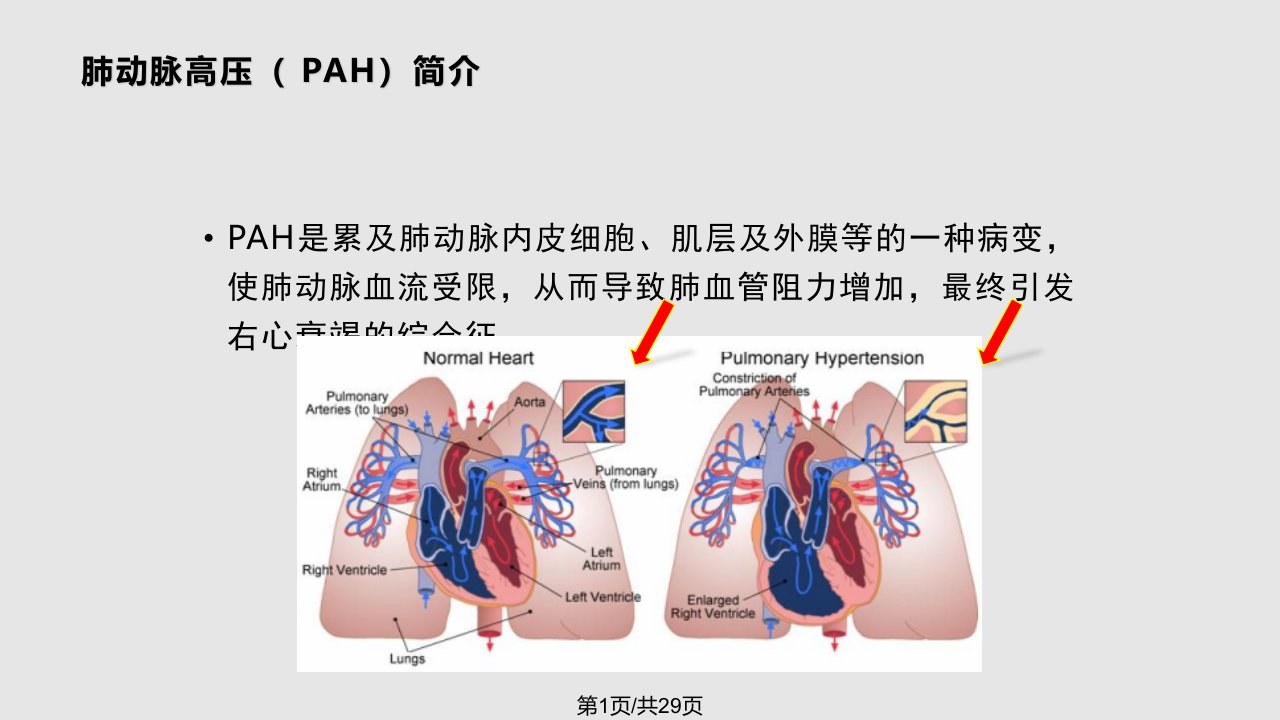 肺动脉高压指南PPT课件