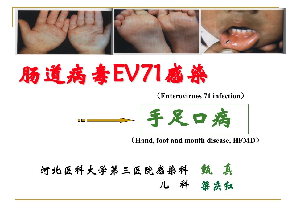 《EV71感染培训》PPT课件