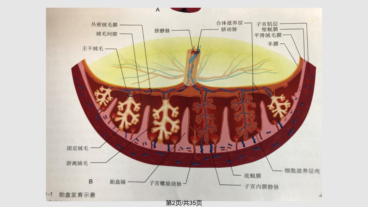 胎盘早剥超声诊断