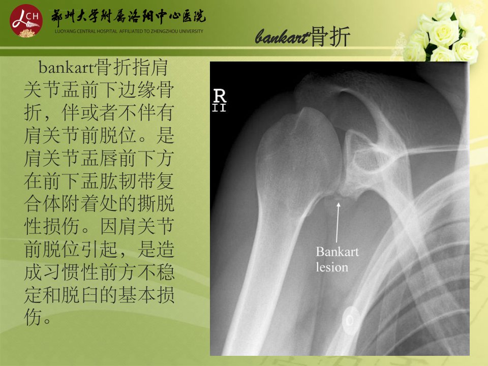 特殊类型骨折ppt课件