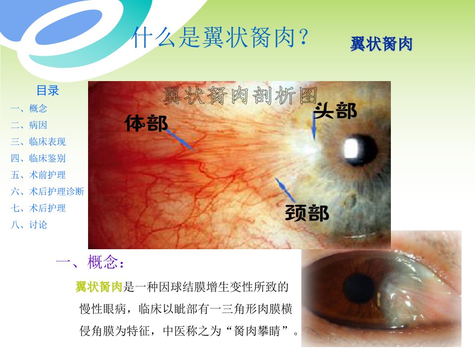 翼状胬肉护理介绍