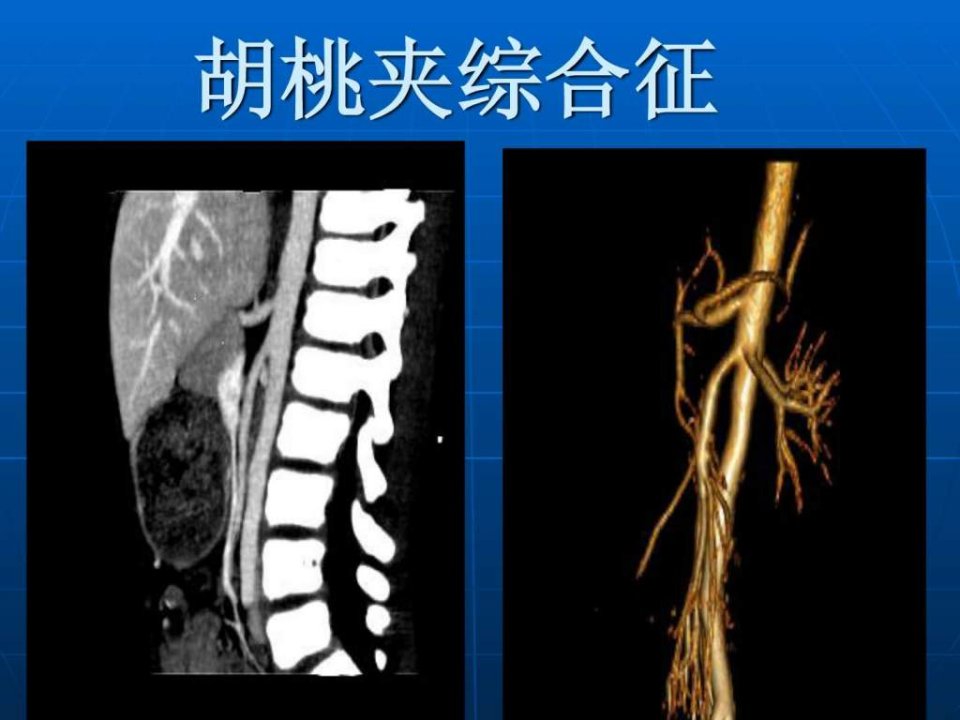 胡桃夹综合征.ppt