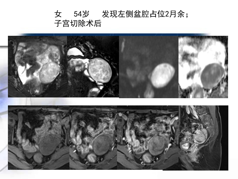 卵巢卵泡膜纤维瘤组肿瘤课件