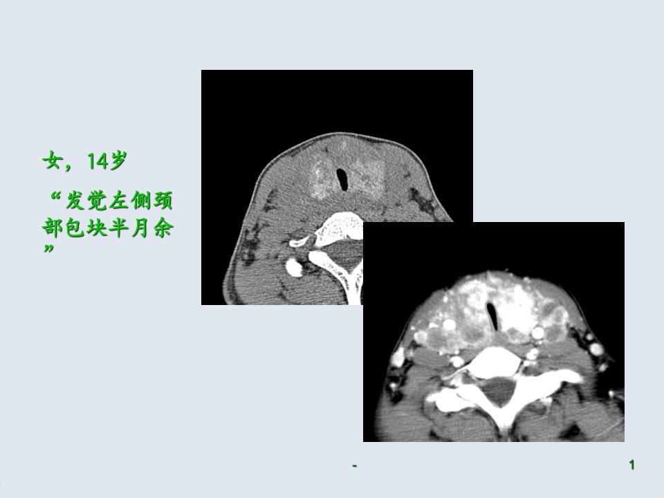 读书报告—小甲状腺癌ppt课件