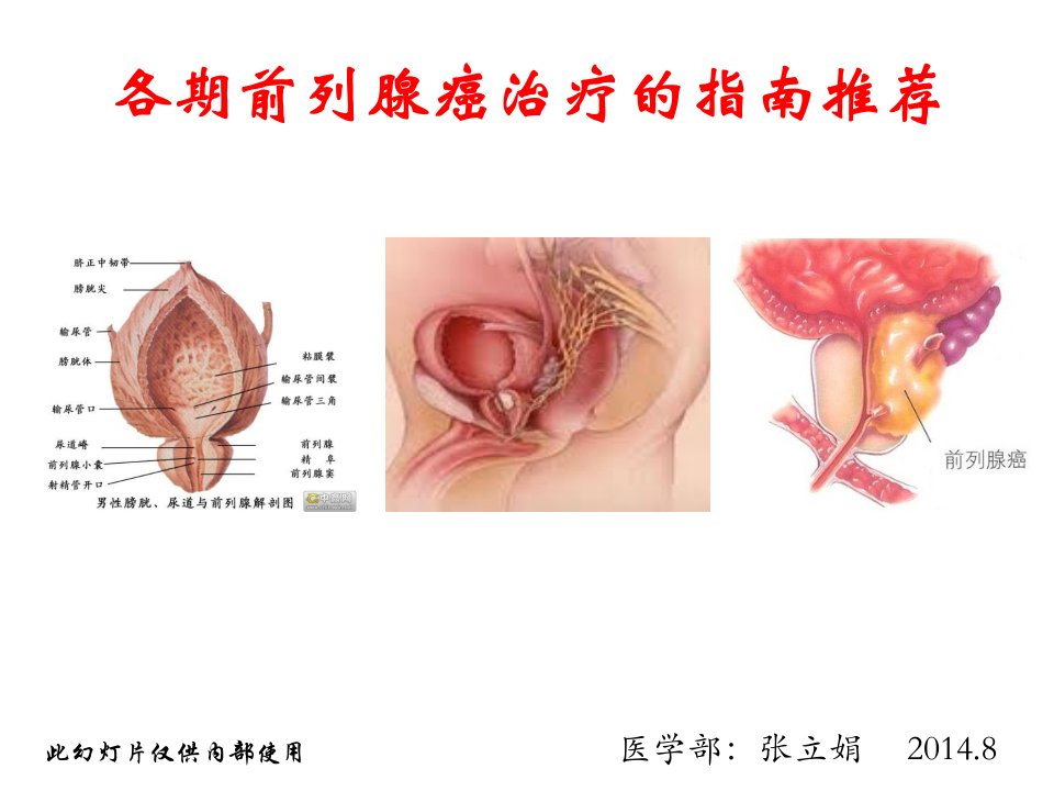 各期前列腺癌治疗的指南推荐ppt课件