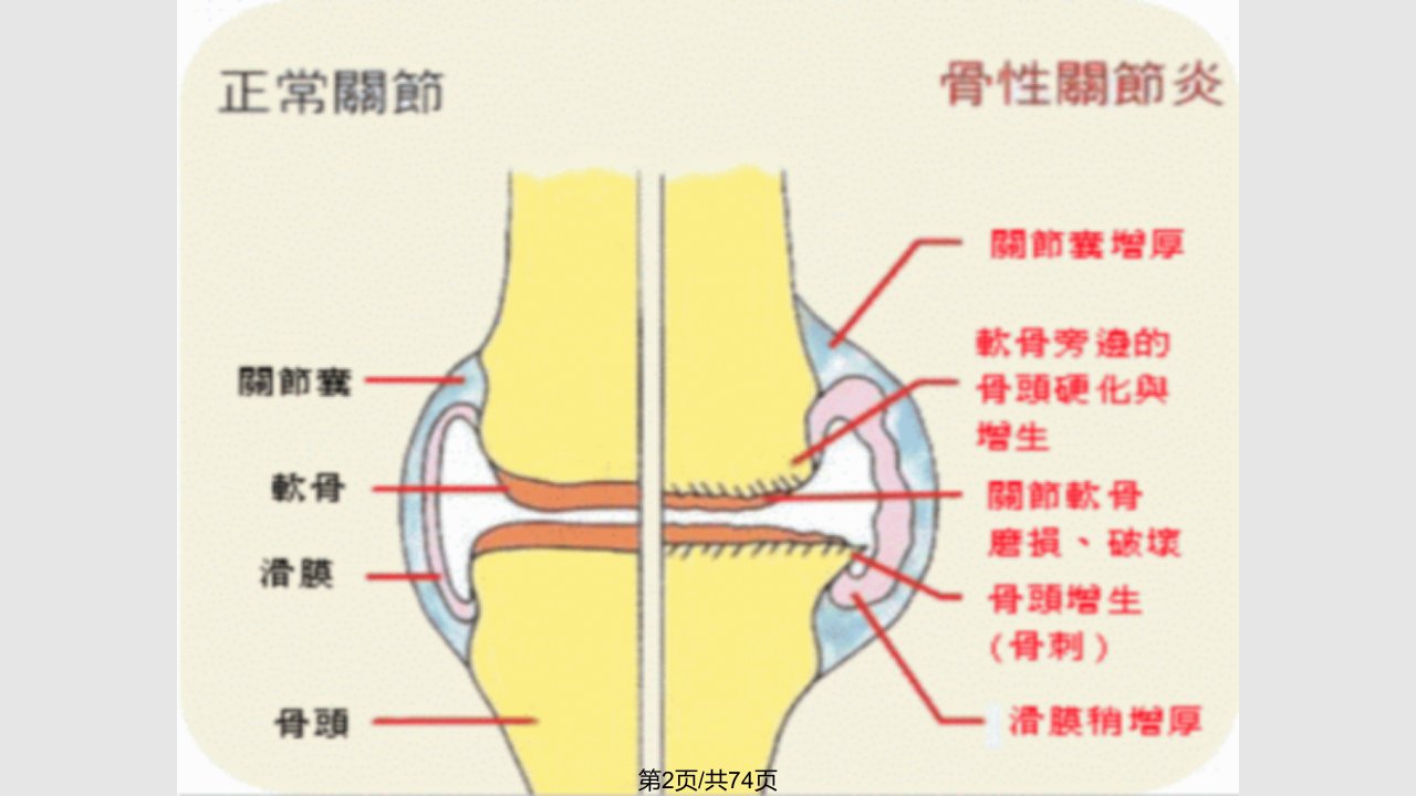 膝关节骨关节炎课件