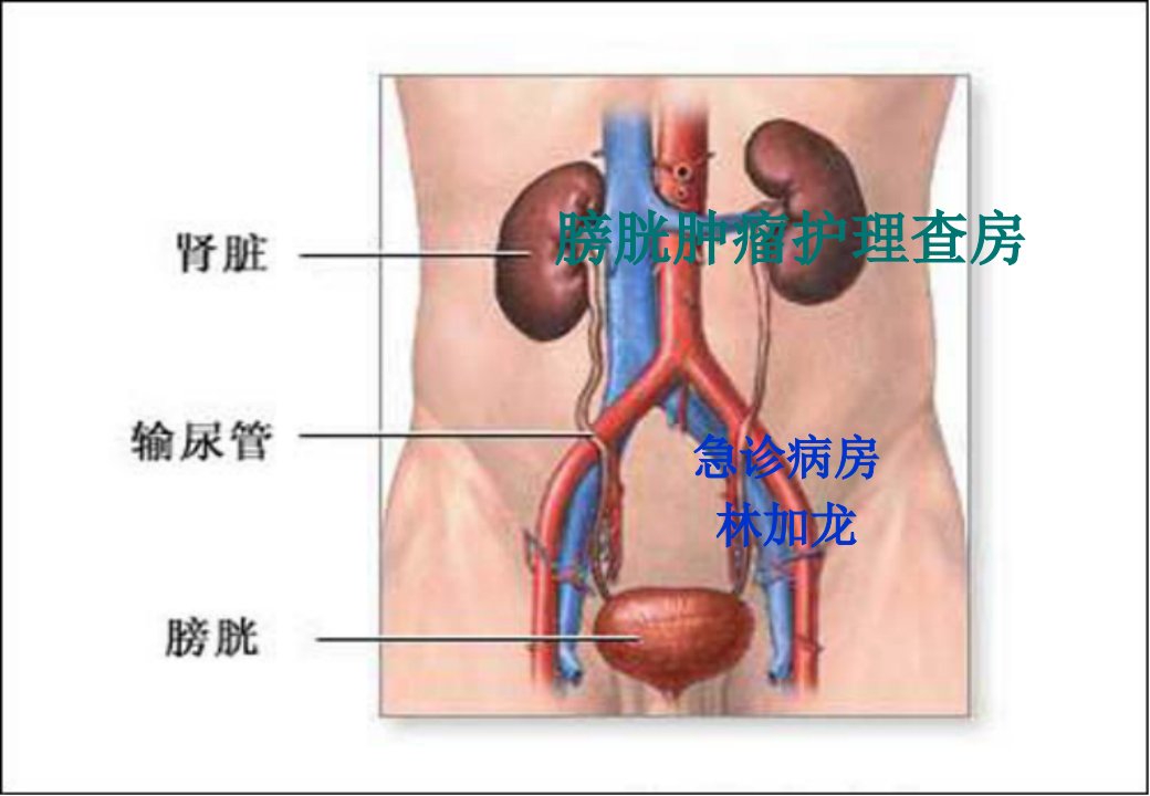 膀胱肿瘤的护理查房