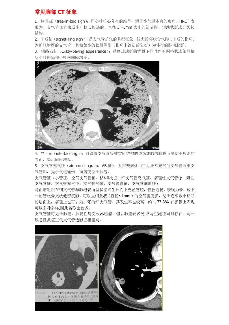 常见胸部CT征象