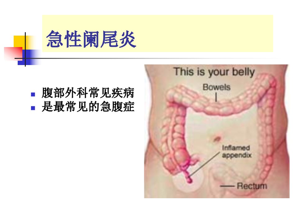 急性阑尾炎(1)