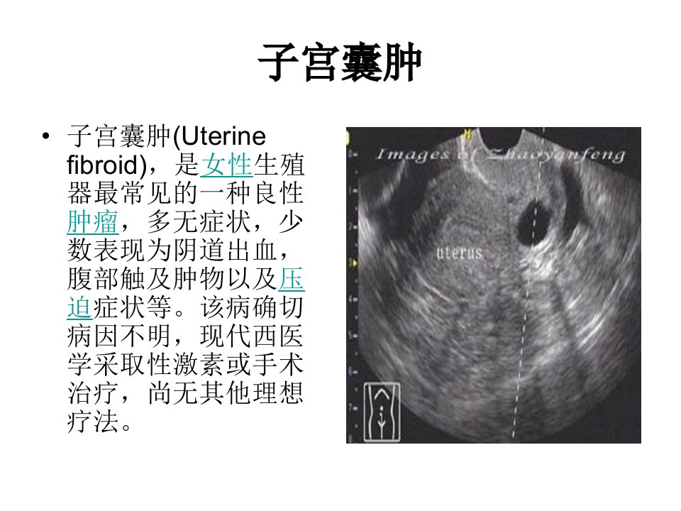 子宫囊肿